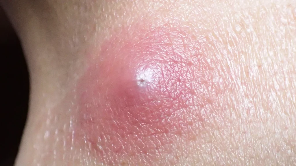 粉瘤