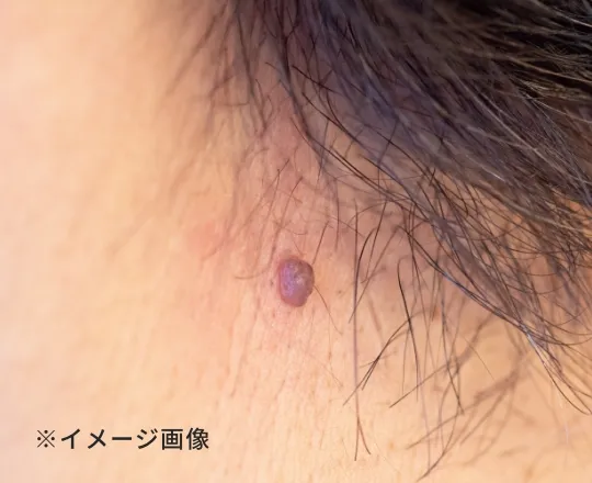 基底細胞がんについて