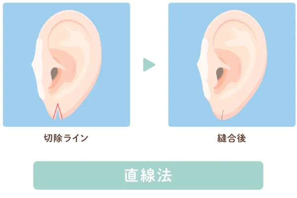 直線法