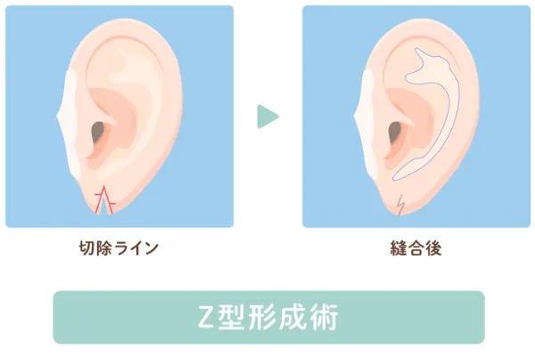 Z型形成術