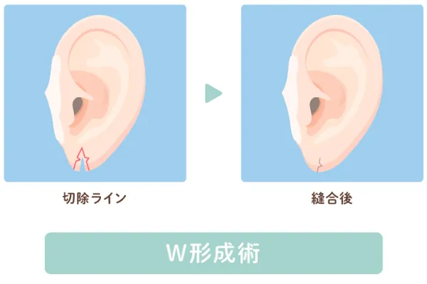 W形成術