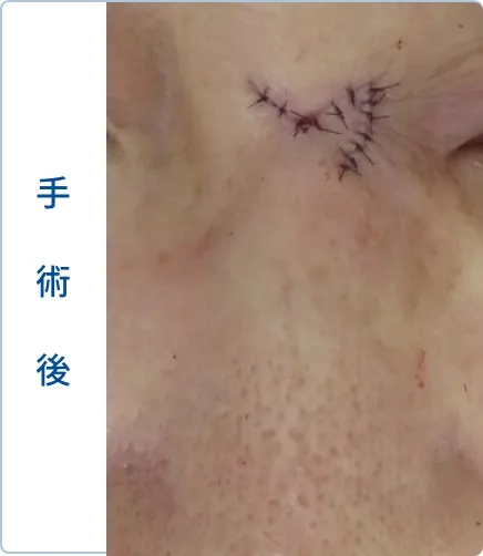 鼻根部の基底細胞がん手術後