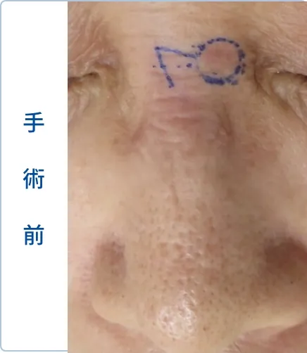 鼻根部の基底細胞がん手術前