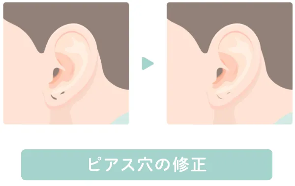 ピアス穴の修正
