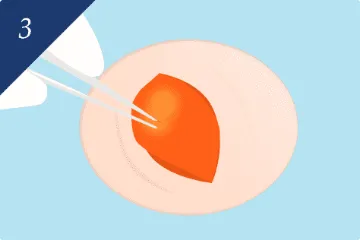 丁寧な剥離と腫瘍の摘出